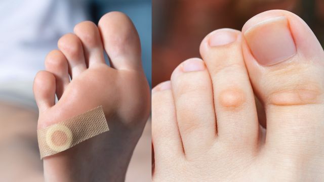 Corns and Calluses - What Are Common Foot Issues Experienced By Hikers