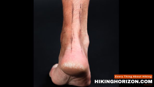 Impact of Hiking on Achilles Tendonitis - Can You Hike with Achilles Tendonitis