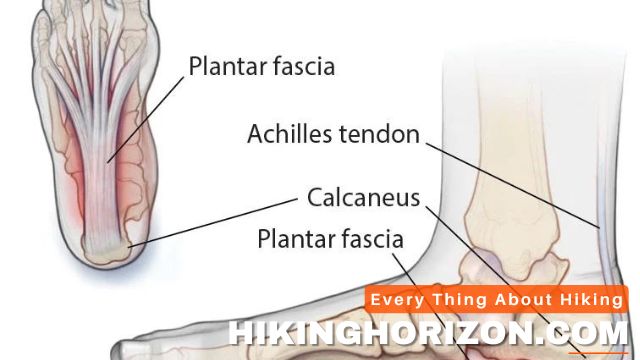 Plantar Fasciitis - What Are Common Foot Issues Experienced By Hikers