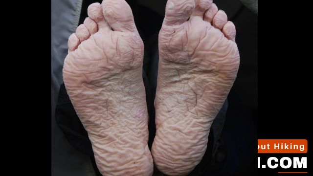 Trench Foot - What Are Common Foot Issues Experienced By Hikers
